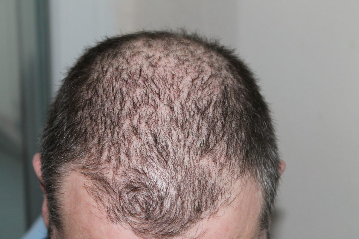 Hair Transplantation: Your Questions Answered